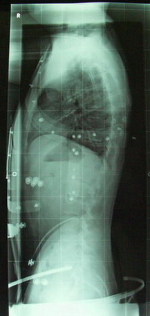 nach 4 Wochen im Korsett
<br />Tragzeit: täglich 10 Std