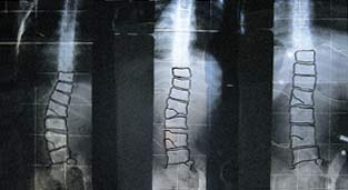 Quelle: http://www.rahmouni.de/skoliose/fehlbildung.htm