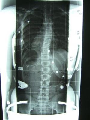 forum_photo-röntgen mit korsett.jpg