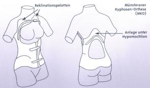 Das ist die Münsteraner-Kyphosen-Orthese, im Prinzip die Bauart die auch Rahmouni bevorzugt, nur daß Rahmouni die Reklinationspelotten anders formt und sie nicht gegeneinander verriegelt.