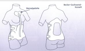 Hier mit zusätzlicher Pelotte, die frontal auf das Brustbein drückt und so die Inklination verhindern soll......