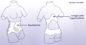 Das ist das Becker-Mieder (ohne Sternalpelotte nach Gschwendt)
