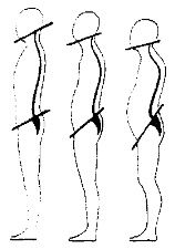 Kyphose und Lordose-Korrektur im "gedachten Milwaukee"