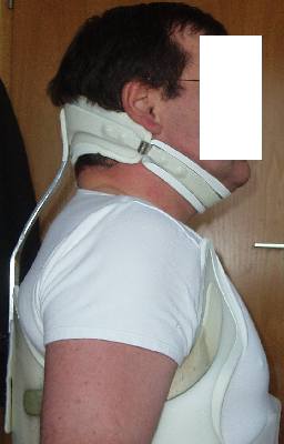 Meine Halsstütze am Rahmouni-Kyphose-Korsett