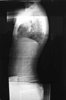 1. vor der korsettthearpie --> 54° COB