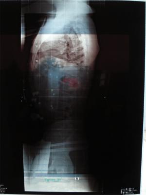 2. aufnahme im korsett nach 3 monaten tragedauer --> 27° COB