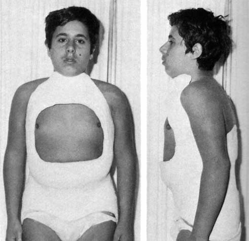 Das ist ein typisches Antikyphose-Gipskorsett