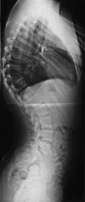Man beachte die kurzbogige Kyphose mit den Keilwirbeln thrakolumbal und die kompensatorische Hyperlordose.
<br />Der Pat. hatte hier häufig Schmerzen.