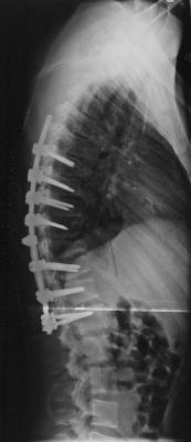 Durch die Ausgradung der BWS stellt sich die LWS automatisch physiologischer ein.