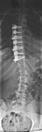 Auch hier wurde nur die strukturelle Hauptkrümmung der BWS korigiert und ich glaube, dass ich dadurch die Beweglichkeit der LWS auf Dauer verbessert habe.