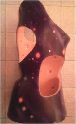 Nachtkorsett (night time brace) hinten