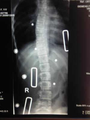 geröntgt im Nachtkorestt liegend Mai 2009 - thorakal 17 Grad -  lumbal 11 Grad
