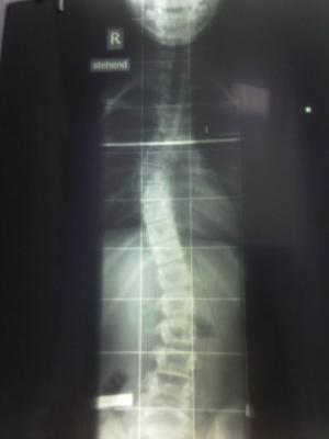 vor Behandlung november 2008 - thorakal 33 Grad
<br />                          lumbal 29 Grad