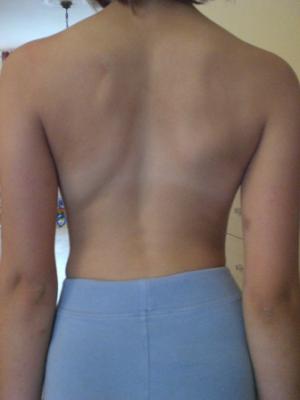 Forum Jana Skoliose.jpg