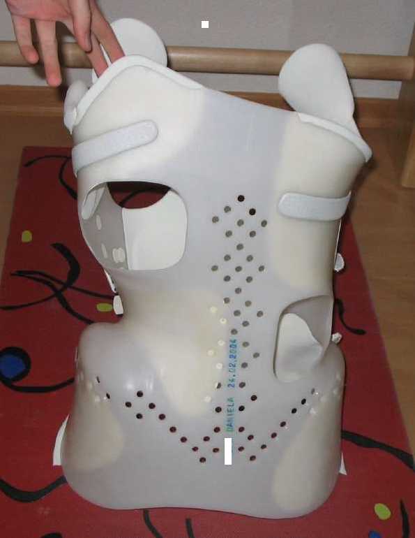 So sieht eine Derotationsorthese von Rahmouni von hinten aus. Man sieht deutlich die Druckzonen mit den Pelotten und die "Fenster" und Ausweichräume in die man hineinatmen kann und soll.