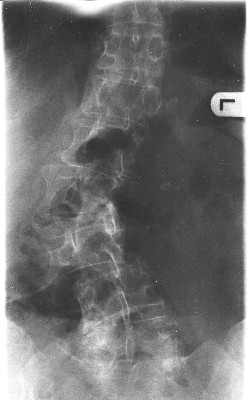 Renate Wirbelsäule klein.jpgmini.jpg