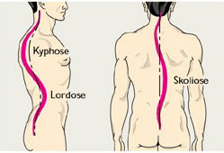 Skoliose Kyphose