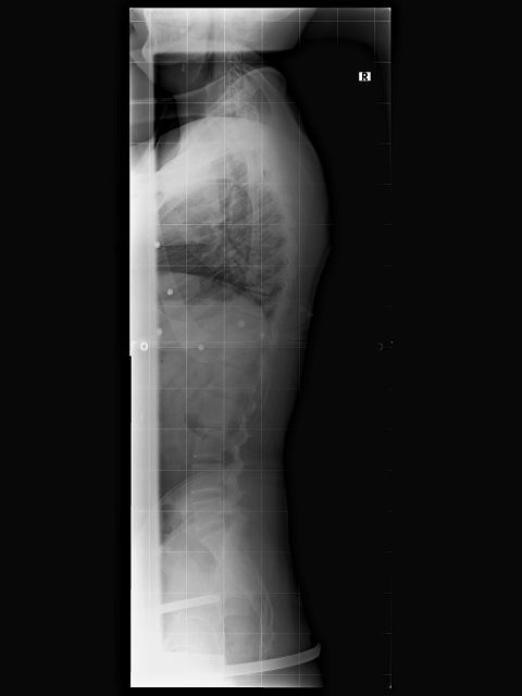 k-45 °kyphose im Korsett.jpg