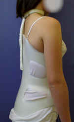 Weiteres Kypho-Korsett mit "franz.Schlinge"