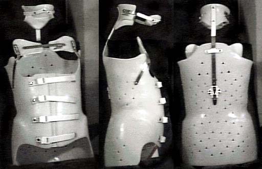 Das war das CTLSO-Korsett eines anderen Bechterew-Patienten.