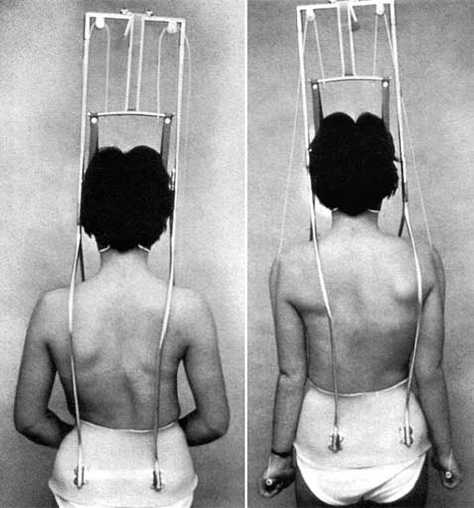 Wirkung der Durocquet-Extension auf eine C-Bogige Skoli!