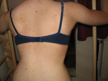 Hier beim Schrothen: 
<br />Die 50° Skoliose ist optisch vollkommen weg!