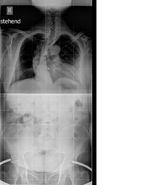 Aufnahme zwei Tage vor der Relaese OP