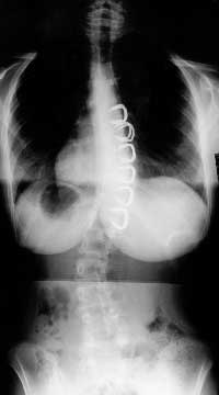 So sieht eine Skoliose mit den Stapling (Klammern) in den WK aus.