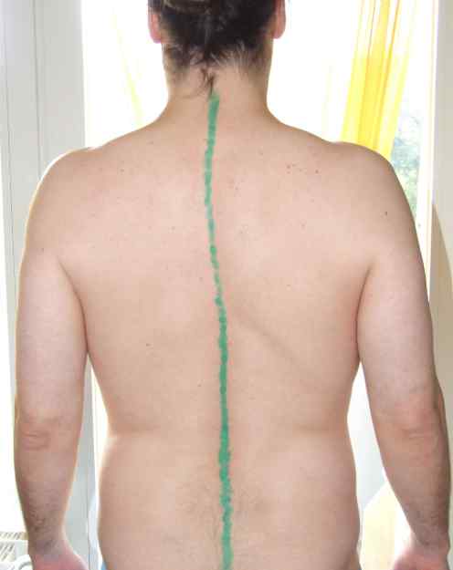 Hier mal ein Bild meiner Skoliose. Im Lenden Bereich habe ich auch noch eine Kurve