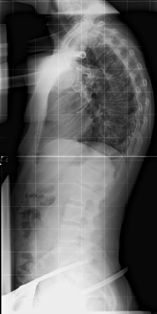 Röntgenbild ohne Korsett