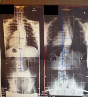 Röntgenbilder vom November 2011 und August 2013 bei Dr. Wilke