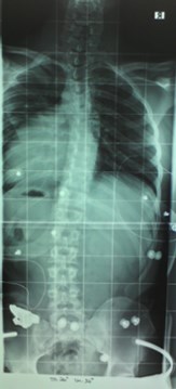 Im Rahmouni-Korsett, 6 Wochen nach Anschulung, Oktober 2010