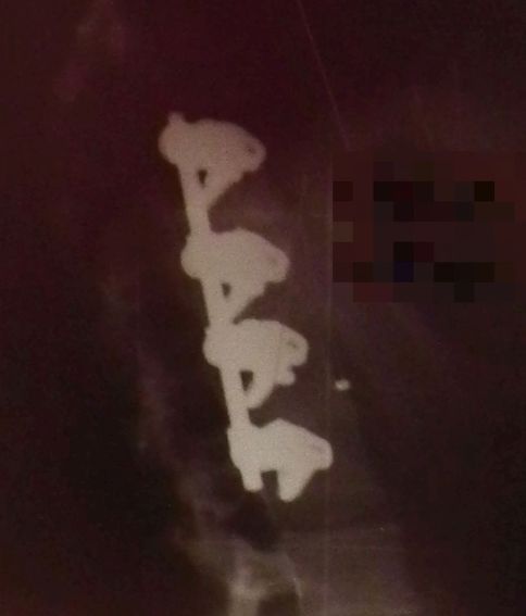 3 Monate Post Op. Der weisse Quadrat ist rechts