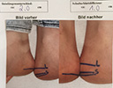 Beinlängendifferenz Tochter, vorher-nachher