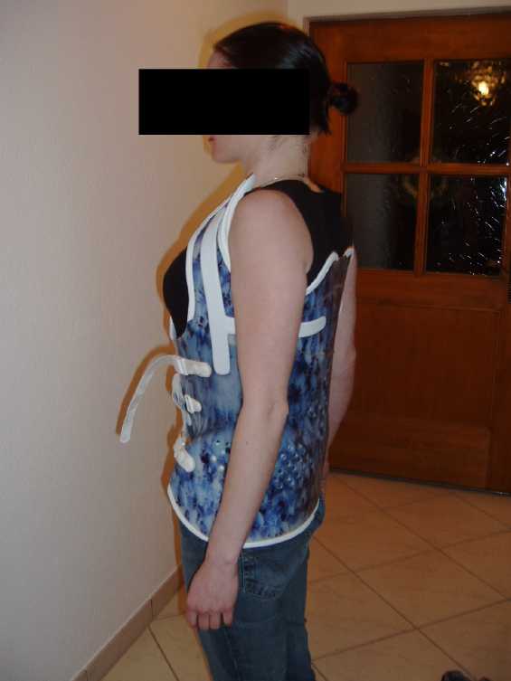 Da sieht man wie ein Rahmouni die Kyphose aufrichtet. Das war der Versuch mit dem Korsett meiner Frau an einer jungen Kyphose......