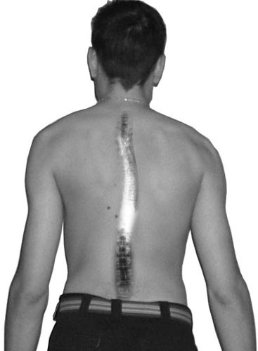 Mein altuelles Röntgenbild retuschiert in eine Rückenaufnahme von mir. (Photoshop sei dank)