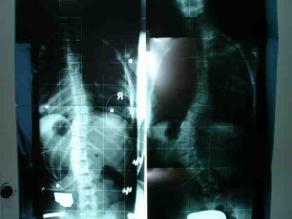 Jennifer vorher und mit Korsett