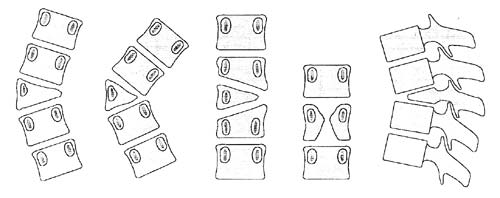 (A) geringeres Verschlechterungsrisiko - (B) größeres Verschlechterungsrisiko - (C) inkarzerierter Halbwirbel / geringes Progredienzrisiko - (D) Schmetterlingswirbel / Wirbelsäule nahezu gerade gebaut - (E) ventral entsteht eine Kyphose.