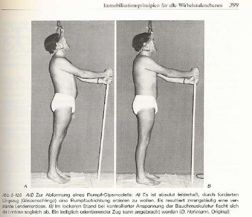 Es ist völlig FALSCH für einen Gipsabdruck ZUVIEL Zug auf die Glissonschlinge zu geben! Das verstärkt sogar Lordose und Kyphose!!!!